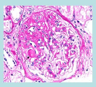 [multiple primary melanoma and familial melanoma. Glomeruloesclerosis focal y segmentaria ...