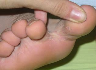 Any one of them could make an individual treatment plan and the patient will have to throw sponges and slippers. Interdigital fungus on feet treatment - Micinorm