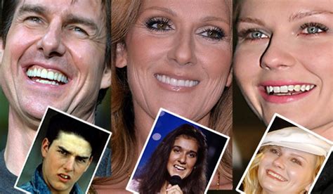 La persistenza dei denti storti negli adulti può essere un residuo infantile oppure derivare da una serie di patologie che si riscontrano, appunto, in età adulta. Denti storti prima e dopo: i sorrisi "rifatti" delle star ...