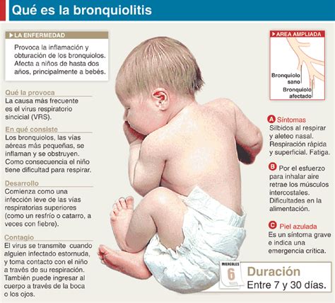 El virus respiratorio sincicial (vrs) es el que más infecciones respiratorias causa cada año en chile. BRONQUIOLITIS NEONATAL