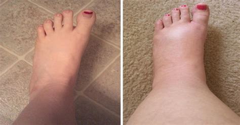 Feet swollen after the plane ride. How To Use The R-I-C-E Method To Quickly Get Rid of ...