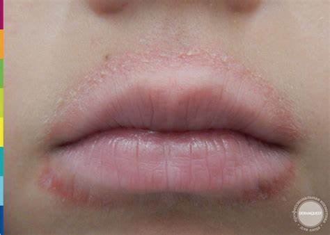 Пероральный дерматит диета примерное меню DERMAQUEST » Периоральный дерматит| Статьи | Отзывы | Купить DERMAQUEST » Периоральный дерматит| Статьи | Отзывы | Купить Пероральный дерматит диета примерное меню