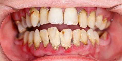 Cara menghilangkan karang gigi yang benar dan efektif. Cara Mudah Cegah Terbentuknya Karang Gigi - VIPPelangi Lounge