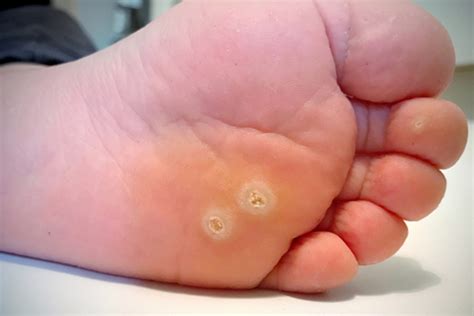But many people choose to remove them because. Plantar Warts | Foot Specialist Toronto | Feet First Clinic
