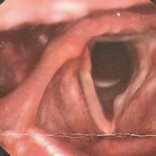 Traditionally, only glottal stop was considered complete closure of the airway. (PDF) Chondrometaplasia of the vocal cord in an adult male