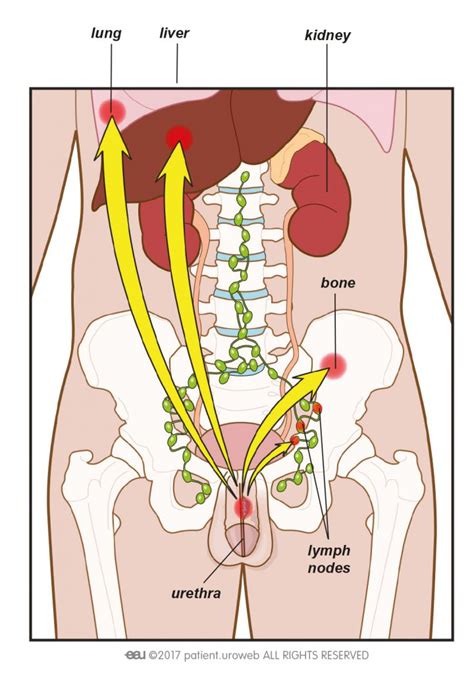 This is called the stage. Testicular cancer - Patient Information