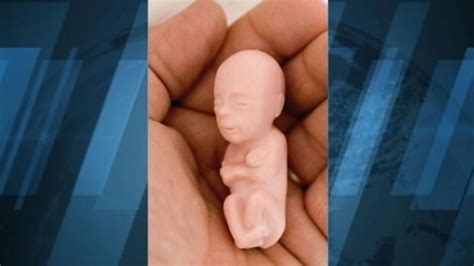 It is a destructive aseptic process that appears between 12 to 24 hours after fetal death. Fetus Dolls Given to Kids at North Dakota State Fair Video ...