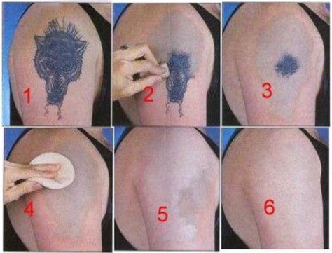 So how does that person remove his tattoos at home by himself? Remove Your Tattoo Naturally | Self Tattoo Removal