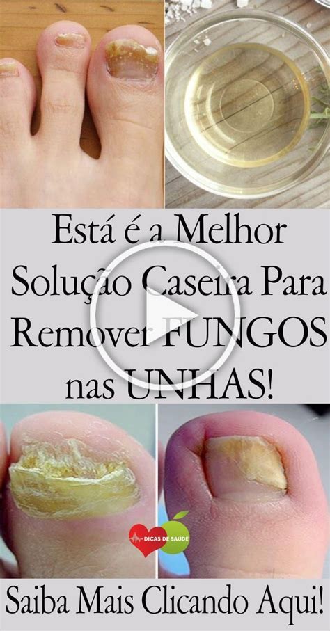 Da mesma forma quando há. Pin de Magaly Oliveira em Fungos nas unhas em 2020 (com ...