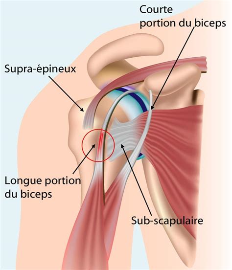 Comment soigner une tendinite