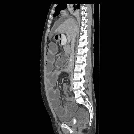 Cecal diverticulitis is an uncommon entity of acute abdominal pain located in the lower abdomen and is often clinically indistinguishable from acute. Cecal volvulus | Image | Radiopaedia.org