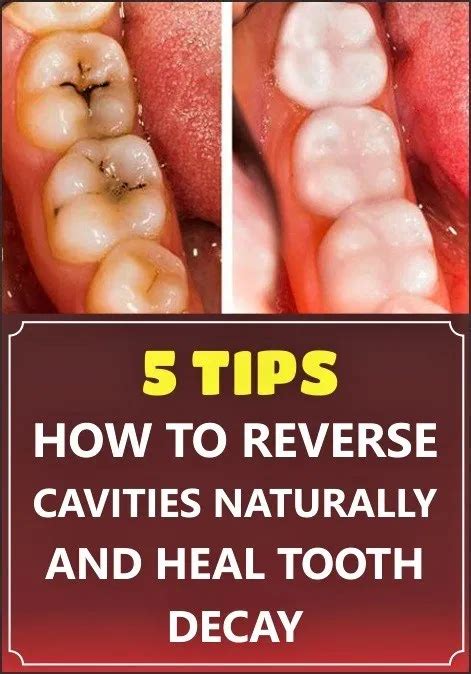 Lack of which may cause tooth cavity and tooth decay, and who doesn't know the pain of an aching tooth? 5 TIPS HOW TO REVERSE CAVITIES NATURALLY AND HEAL TOOTH ...