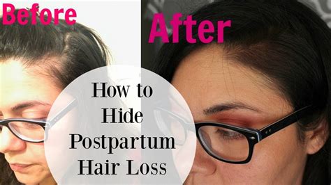 Below is some useful nutrition and stress also impact hormone levels, and they also affect hair growth. How to Hide Postpartum Hair Loss! - YouTube