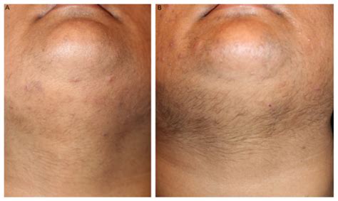 However, these studies were highly paradoxical in nature. FAQ: Laser Hair Removal - Aurora Electrolysis