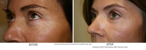 However, costs vary widely depending on. LASER RESURFACING | Reveal Your Fresh New Face