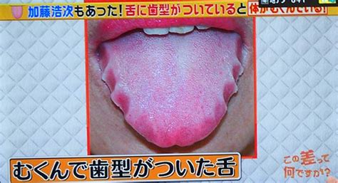 健康發展 / 健康发展 ― jiànkāng fāzhǎn ― sound. 舌の色が薄い、歯型がつく、色が濃いで健康状態がわかる | 病気情報