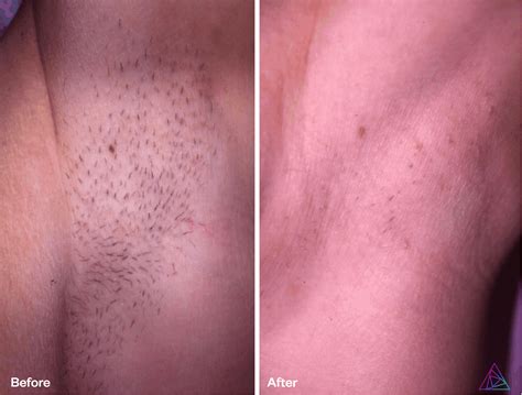 Laser hair removal for men and women. Laser Hair Removal - Vanish Laser Clinic Alexandria VA