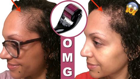 My general perception is the process of microneedling at the superficial level of hair in women may induce some inflammation, which causes the hair to go into telogen or shedding phase. Shedding Microneedling - How Scalp Microneedling Can Cause ...