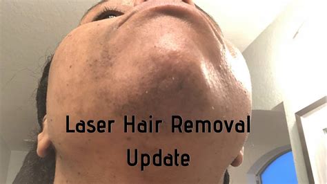 Why laser hair removal favored fair skin and dark hair. Has laser hair removal worked | Dark Skin | Yag Laser ...