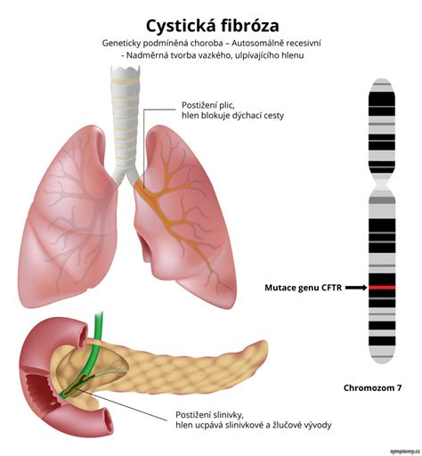 Cystická fibróza je závažné dědičné onemocnění, které je označováno za progresivní, tj. Cystická fibróza - příznaky a léčba