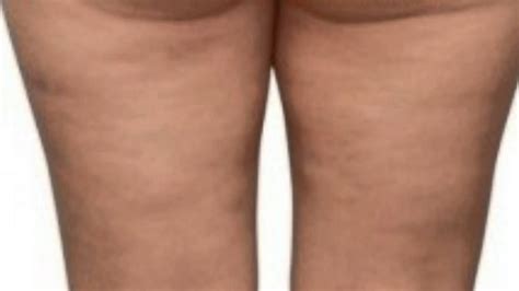 Das cellulite problem hatte uns jetzt also alle fest im griff. Natürliche Behandlung Zu Hause Und Preiswert Für Cellulite ...