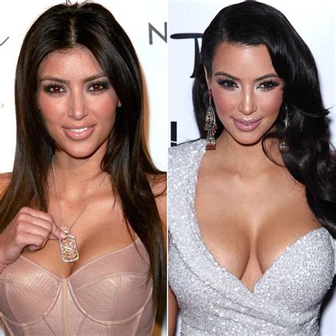 More images for kim kardashian before after » Top 25 Most Expensive Celebrity Plastic Surgeries