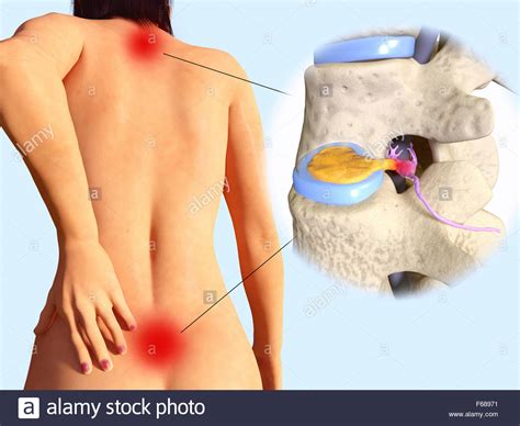 Pain typically occurs in the lower back, side, and groin. Illustration of a woman in pain due to slipped discs (one at right) A Stock Photo - Alamy
