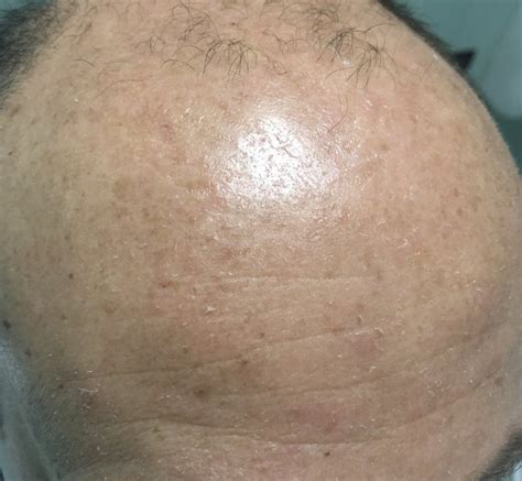 Dermatite seborroica? - Dermatite seborroica - DermaClub Forum