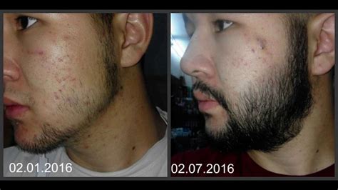 So, finally, it is your chance to sport the thick minoxidil beard after hundreds of men who have successfully tried the minoxidil formula and are now flaunting their stylish beard get overs. Minoxidil Beard Growth: Real Before and After Photos