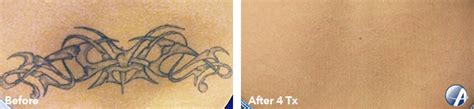 Patients who smoked had a 70% less success rate compared to their counterparts. Before and After Pictures | Results | Louisville Tattoo ...