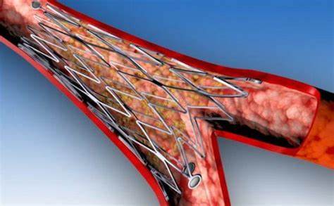 Стентирование сосудов сердца: стоимость операции, реабилитация и Картинка - Стентирование сосудов сердца: стоимость операции, реабилитация и