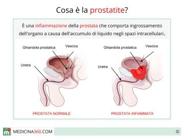 Il peperoncino, in cui è presente la capsaicina che ha un effetto dilatatore, va bene ma in piccole quantità, perché in eccesso diventa irritante per la prostata. Prostata ingrossata: sintomi, cause, cura, rischi, dieta e ...