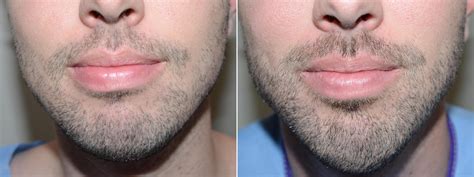 And if you don't want to go the facial hair removal. Facial Hair Photos | Miami, FL | Patient 58915