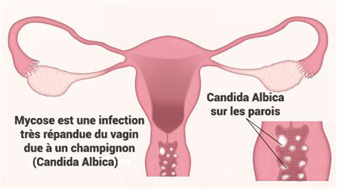 Les mycoses vaginales, lorsqu'elles se répètent, peuvent devenir très désagréables, voire insupportables. MYCOSE VAGINALE - Santé des jeunes