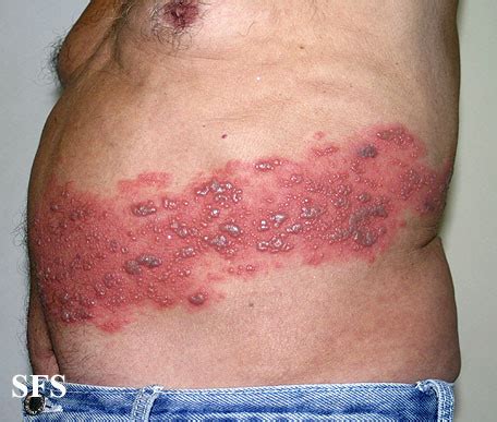Although there are is no cure for herpes, there are ways to prevent its spread and treat outbreaks. Herpes Zoster Virus Infection (Shingles) Facts, Pictures ...