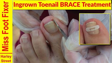 Ingrown toe nails are common among the pedicure world. Ingrown Toenail Brace Treatment Miss Foot Fixer Marion Yau - YouTube
