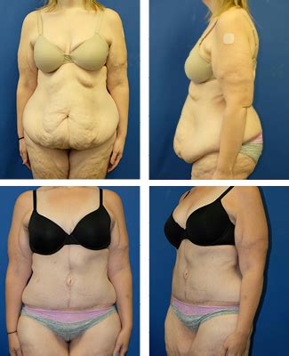 Removes stubborn areas of fat. Lower Abdomen Reduction - Mayo Clinic Health System