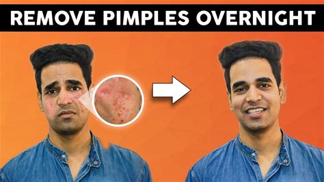 I am staying in hostel/pg for past 5 years and i have to share toilet. How to Remove Pimples Marks from Face for Men 2020 - YouTube
