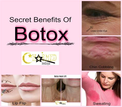Secret Benefits Of Botox - Charmed Medispa