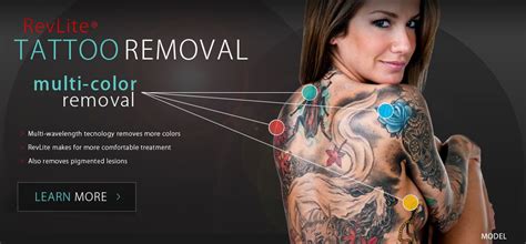 The revlite laser is still considered the gold standard for nanosecond laser tattoo removal, and we find it very effective on removing red ink pigment in tattoos. Accents Cosmetic Surgery Announces New RevLite Laser ...