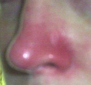 How to Get Rid of an itchy nose fast - Causes ...