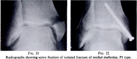 PDF The treatment of displaced fractures at the ankle by ...