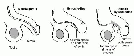 Hipospadia adalah kelainan bawaan sejak lahir dimana letak pembukaan uretra berada di bawah penis. Be Positive Nurse: Makalah Hipospadia,Kelainan Jantung dan ...