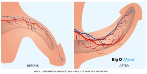 If you have a foreskin, pull it back gently and wash underneath. Peyronie's Disease Treatment