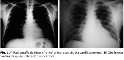 A viral infection usually causes myocarditis, but it can result from a reaction to a drug or be part of a. Miocarditis aguda y meningoencefalitis por Trypanosoma cruzi en un paciente seropositivo al VIH