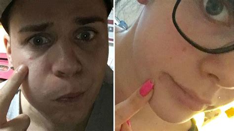 Seit der trennung von henning merten steht anne wünsche bei insta im kreuzfeuer der kritik! Power-Duo mit Pickel: Anne Wünsche leidet mit Verlobtem ...