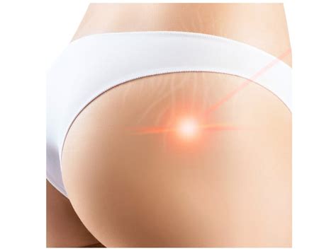 Because your eye has more or less settled into its final form by the time you reach your late teens, wallerstein said that, given a medical history that checks out, patients as young as 18 years old can be excellent candidates for a lasik procedure. How to get rid of stretch marks - Netmums Reviews