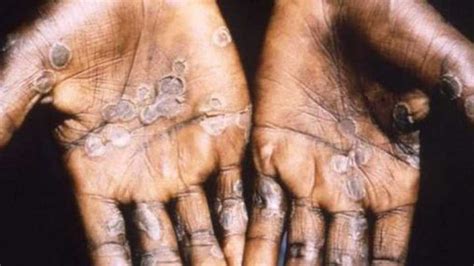 Monkeypox virus belongs to the orthopoxvirus genus in the family poxviridae. Case of monkeypox confirmed in England after patient had ...