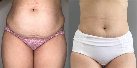 111 harley street, london, united kingdom. Tummy Tuck Surgery and Treatments from 111 Harley St.
