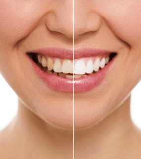 Veneers refer a safe cosmetic dentistry technique done to improve the appearance of teeth. Dental Treatment in Turkey | Dental Implants Turkey ...